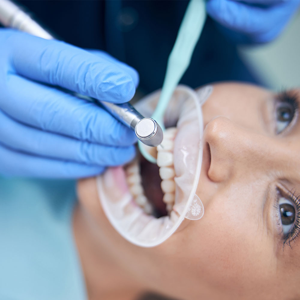 Zahnfüllungen – Der Effektivste Weg Zum Schutz Ihrer Zahngesundheit